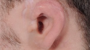 Médicos reconstruíram orelha de Hogg com pedaço de sua costela (Foto: BBC)